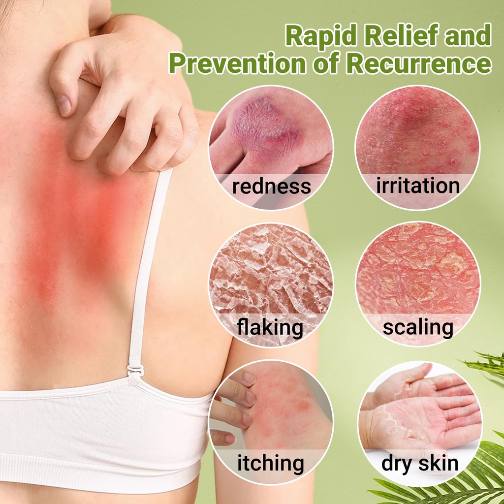 psoriasis-cream-maximum-strength-treatme-3.jpg