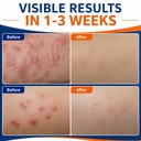 mite-cream-itch-relief-fast-lasting-plea-71oJmIlUMgL.jpg