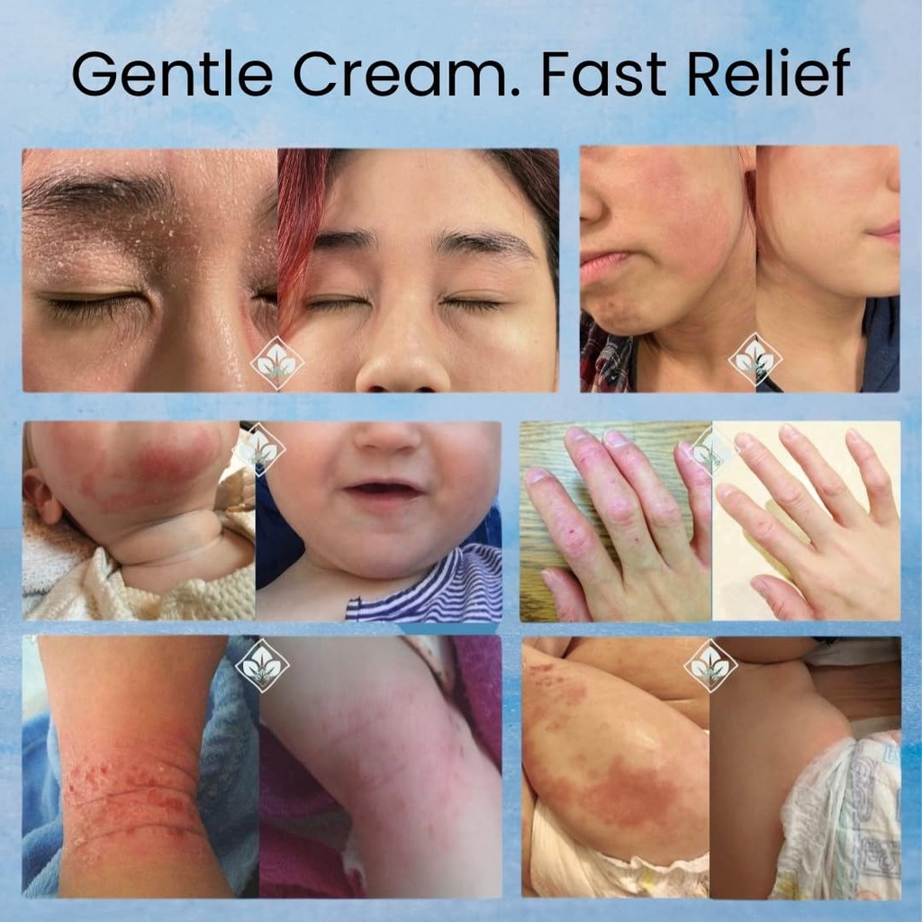 baby-eczema-cream-for-dry-itchy-skin-soo-6.jpg