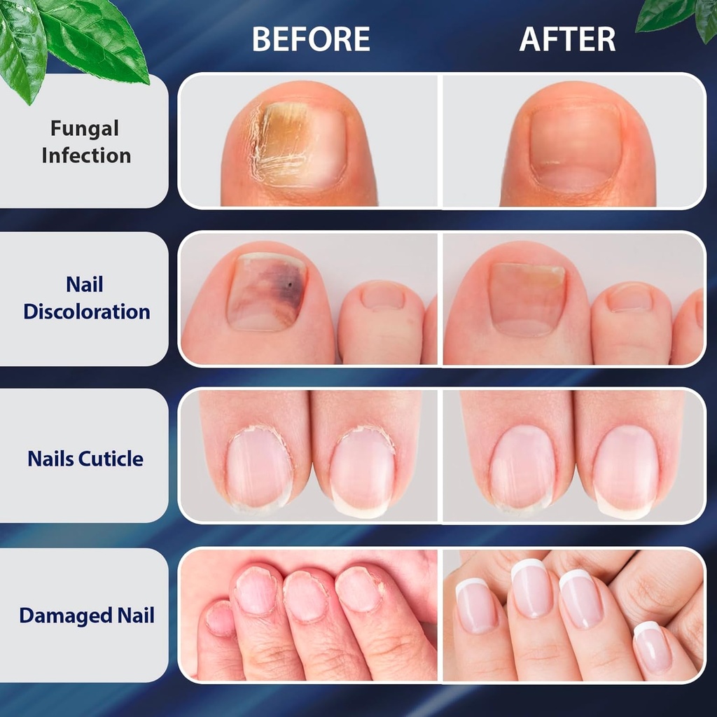 tobcharm-toenail-fungus-treatment-extra--4.jpg