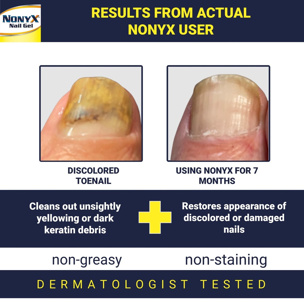 nonyx-fungal-nail-clarifying-gel-clinica-2.jpg