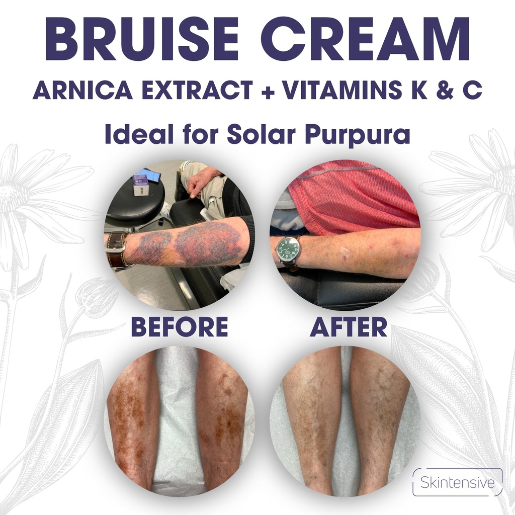 skintensive-arnica-bruise-cream-for-thin-5.jpg